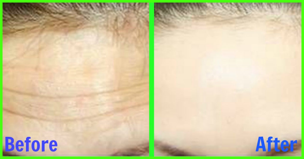 Remove Wrinkles Naturally At Home