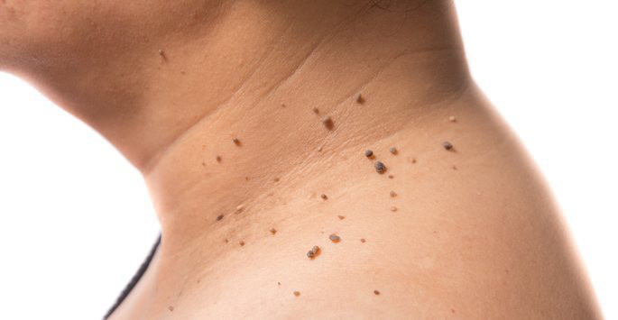 skin tags on neck causes