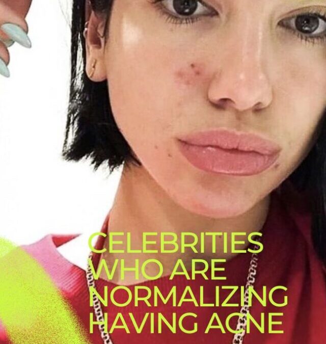 CELEBRITIES WHO ARE NORMALIZING ACNE  BY GETTING REAL ABOUT THEIR STRUGGLES